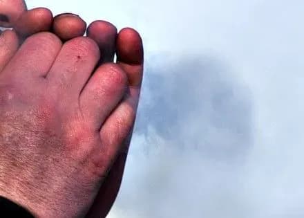 Двух людей с обморожениями конечностей госпитализировали в Кропивницком