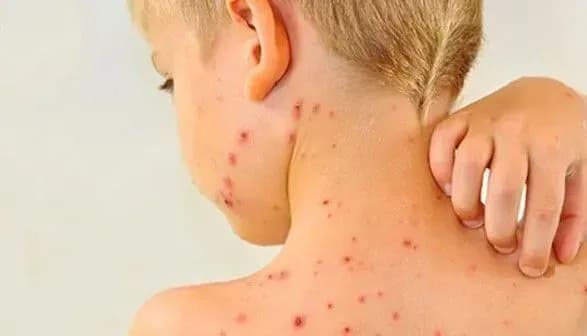 У листопаді на Запоріжжі зафіксовано 70 випадків захворювання на кір