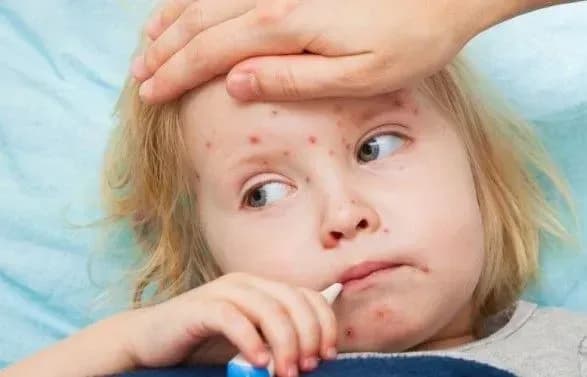 У Києві зареєстровано близько 80 випадків захворювання на кір