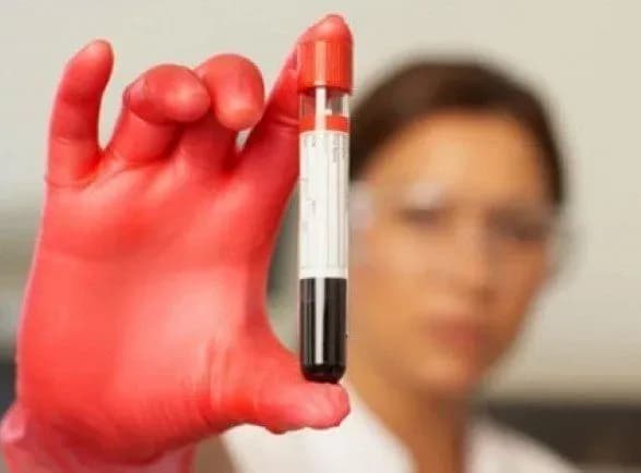 У МОЗ переконують, що епідемії гепатиту А в Україні немає