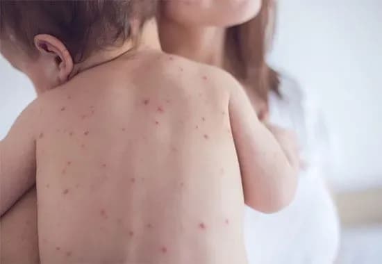 Через підвищену захворюваність на кір одеським школярам продовжили канікули