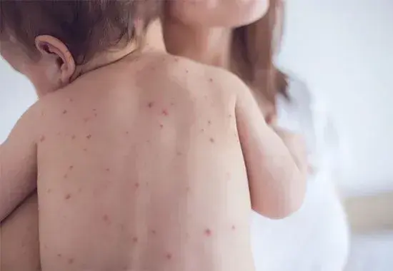 Через кір у столиці госпіталізовано 15 людей