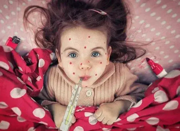 Спалах кору в Україні прийшов з Румунії - Супрун