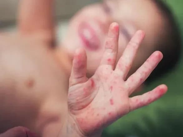 Вчора від кору померла ще одна дитина - Супрун