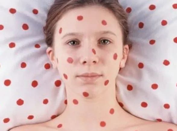З початку 2018 року в Україні на кір захворіло 1500 людей - Супрун