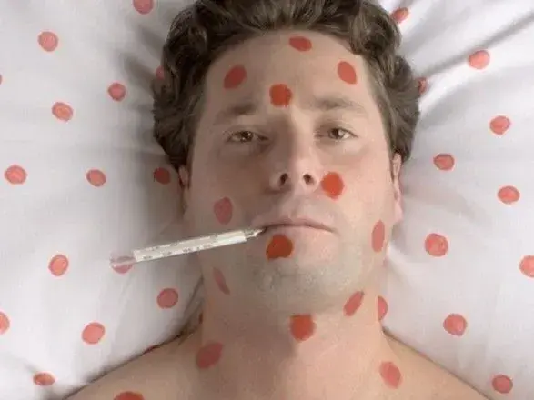 Протягом тижня на Закарпатті зафіксували 137 нових випадків кору