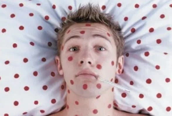 В Минздраве ожидают повышения уровня заболеваемости корью