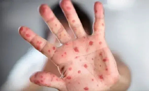 В Івано-Франківську померла молода жінка, попередньо від кору