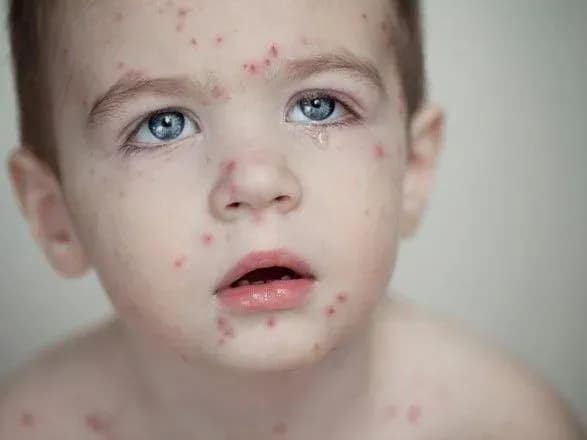 КМДА: у лютому в столиці зафіксовано 13 випадків кору