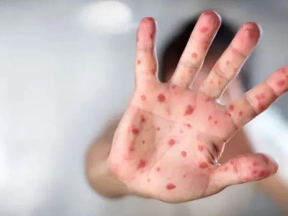 З початку року в Україні від кору померли 5 осіб – МОЗ