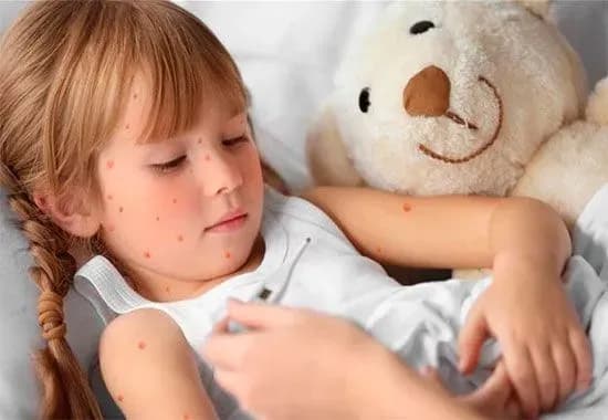 В Україні на кір вже захворіли більше 4 тисяч осіб – МОЗ