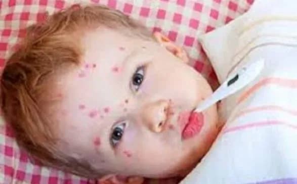 На Кіровоградщині підтвердили 18 випадків кору