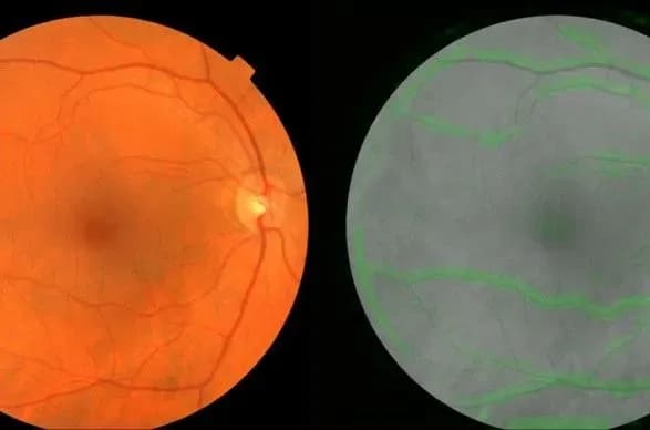 Штучний інтелект навчився пророкувати проблеми з серцем, скануючи сітківку