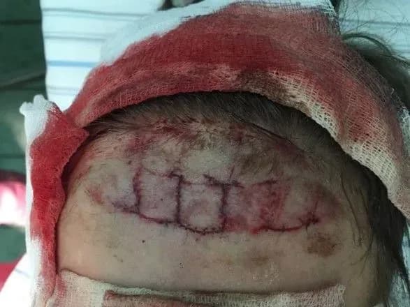 У київському аквапарку на дитину впала частина гірки