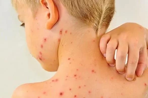 Одеська область отримає 20 тисяч доз вакцини проти кору