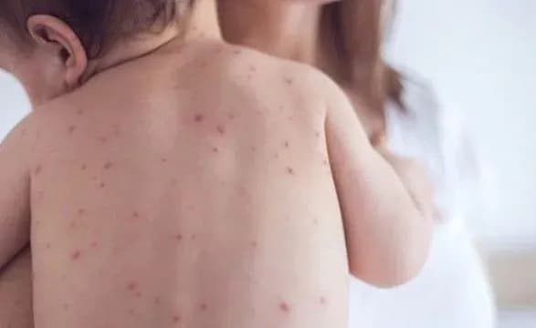 Более 100 случаев кори обнаружили в Донецкой области