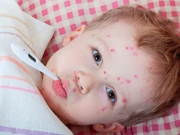 Понад сотню нових випадків кору зафіксували протягом тижня на Закарпатті
