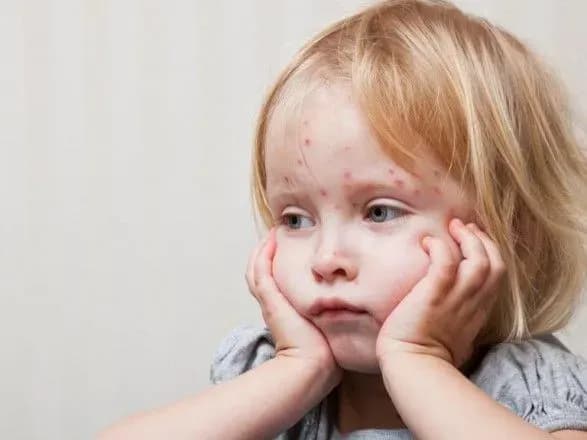 В Киевской области госпитализировали с ветрянкой и корью 11 человек