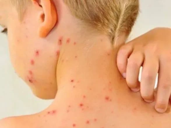 Более 10 новых случаев кори зафиксировали в Кировоградской области