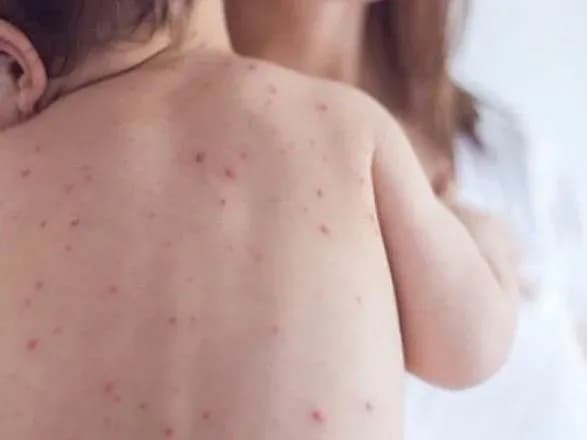 Ще 12 нових випадків кору зареєстрували на Кіровоградщині