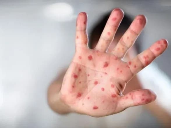 Кір в Україні: за тиждень захворіло більше тисячі людей