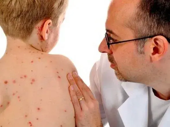 За рік захворюваність на кір в Україні збільшилася в 70 разів - нардеп