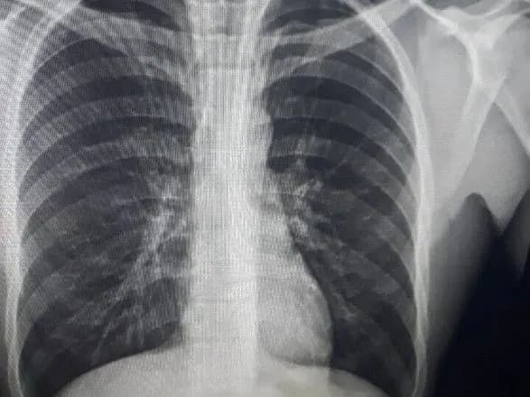 Пограбував та проковтнув каблучку: на Полтавщині засудили обвинуваченого у розбої