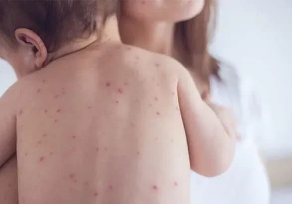 Більше 70 дітей за тиждень захворіли на кір у Львівській області