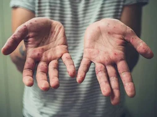 Кількість хворих на кір в Україні за тиждень зросла на 10%