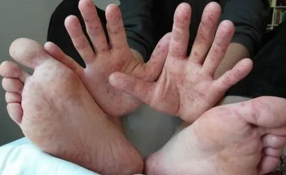 На Харківщині зафіксували спалахи кору