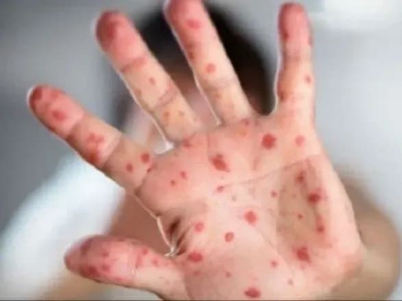 Масштабний спалах кору на Одещині: хворі не щепилися через релігійні переконання