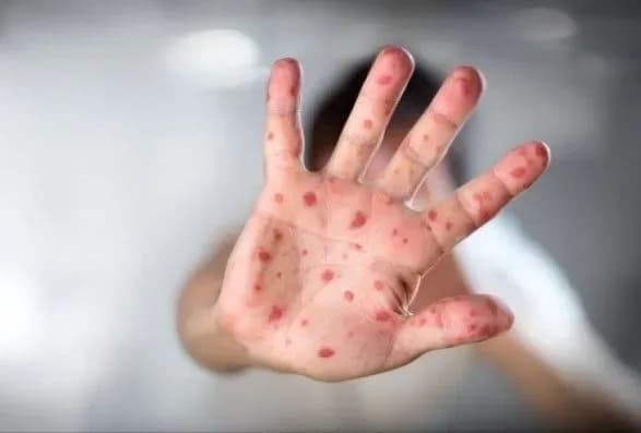 В николаевском интернате корью заболели 12 человек