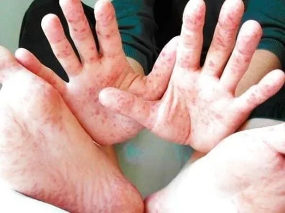 Спалах кору в Одеській області: захворіло вже 84 дитини