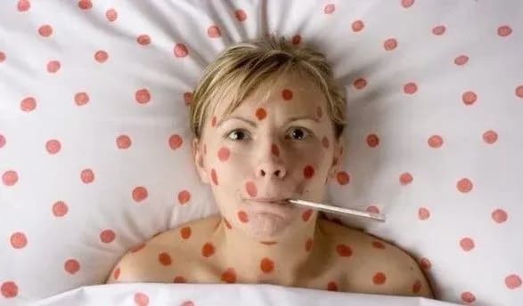 В Україні не будуть оголошувати епідемію кору - МОЗ