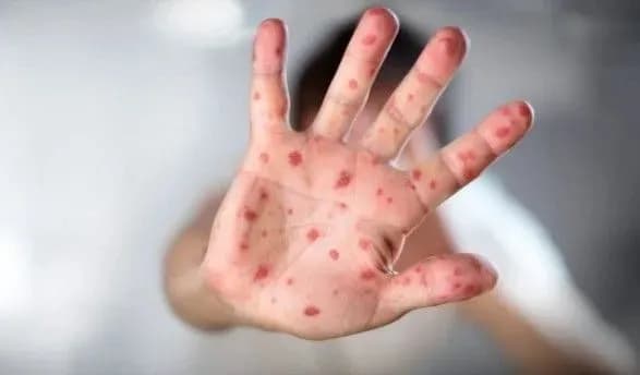 В Україні третій рік поспіль зростає захворюваність на кір