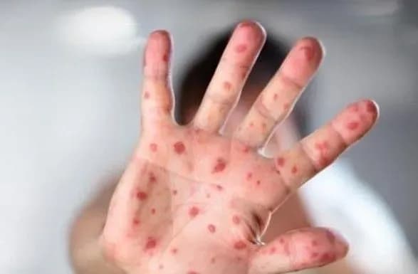 Хворих на кір в Україні більше, ніж в усій Європі