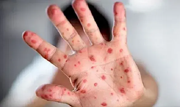 У Грузії продовжує зростати захворюваність на кір