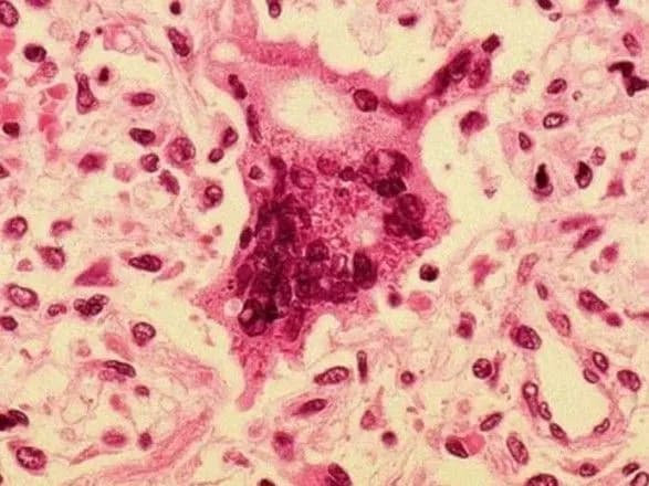 На Прикарпатті майже 40% хворих на кір не мали щеплення