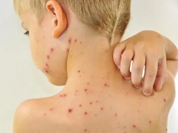 З початку року в Житомирі зареєстровано 140 випадків захворювання на кір