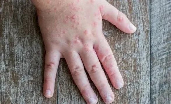 У Криму зафіксували спалах кору