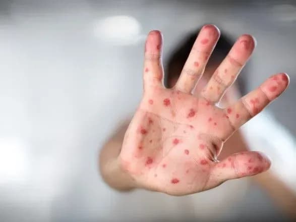 З початку року на кір захворіло понад 39 тисяч українців