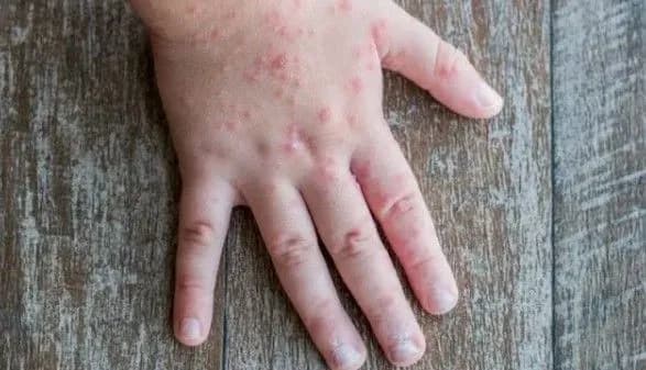 У харківському університеті з початку року зареєстрували 44 хворих на кір