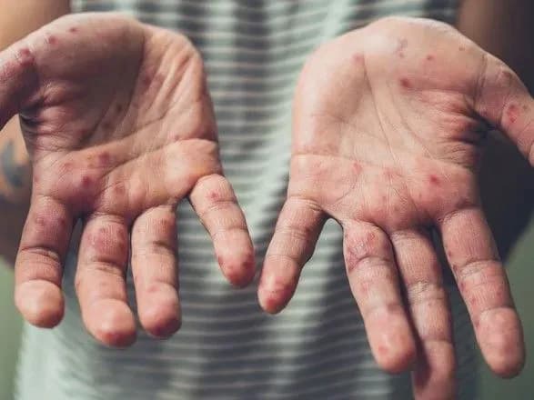 У Севастополі через листівки закликають терміново вакцинуватися проти кору