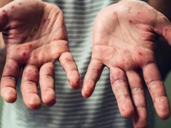 Майже три чверті випадків кору в Європі зафіксовані в Україні - ВООЗ