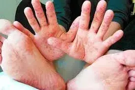 З початку року від ускладнень кору померли 18 людей