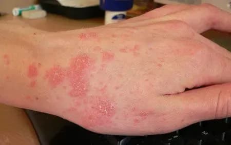 В Молдове несколько детей умерло от лечения чесотки и педикулеза