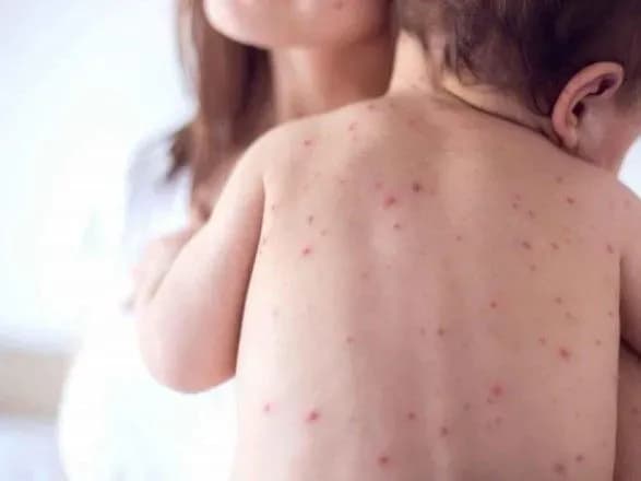 З початку року на кір в Україні захворіли понад 55 тис. людей