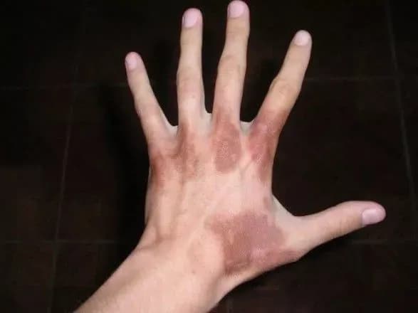 Алергологи назвали рослину, якої не варто торкатись