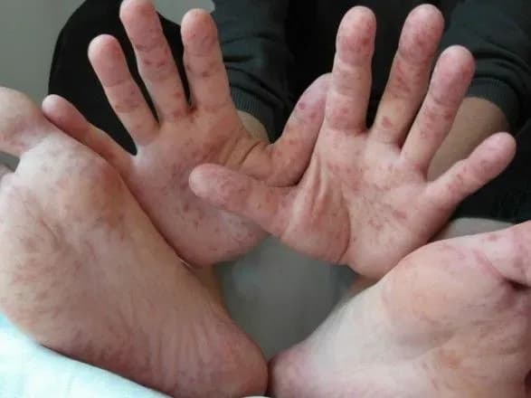 З початку року на кір в Україні захворіли понад 56,5 тис. людей