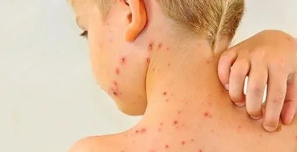 З початку року на кір в Україні захворіли вже понад 57 тис. людей